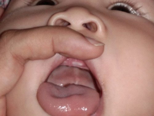 นี่คือฟันกำลังขึ้นใช่มั๊ยคะ?