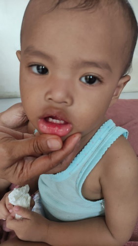 Bun tanya dongs, ada yg pengalaman anaknyaa sariawan? Mohon saran bund, anak umur 1th 7bulan