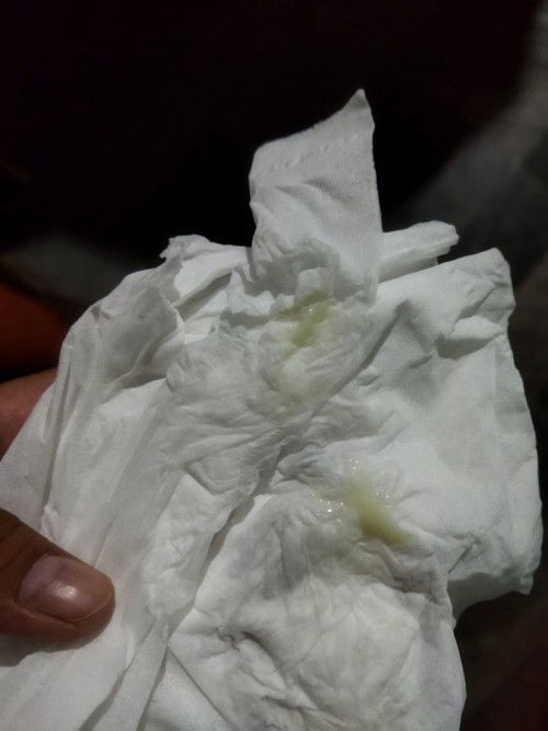 ตั้งครรภ์ 37+3 มีอาการ