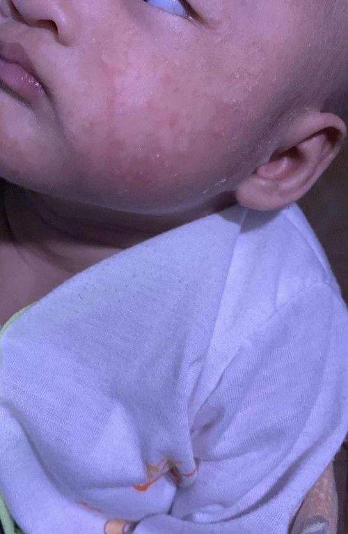 Cara menghilangkan ruam akibat asi