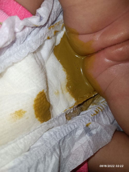 3weeks old c baby,

Mga Mii, sino Dito bona user tapos basa Ang poop ni baby normal lng Po ba sa age