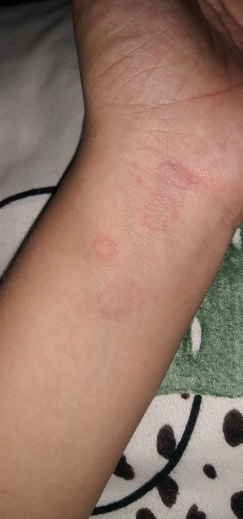 Mga Momsh, nangangati din ba balat niyo especially sa kamay at leeg?