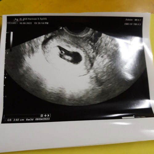 Perbedaan usia kandungan berdasarkan hpht di aplikasi & USG