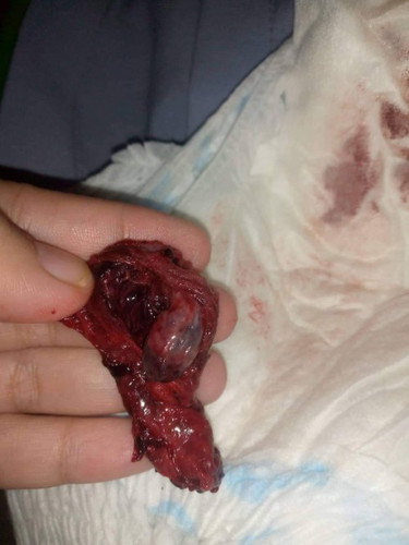 Bleeding or Mescariage