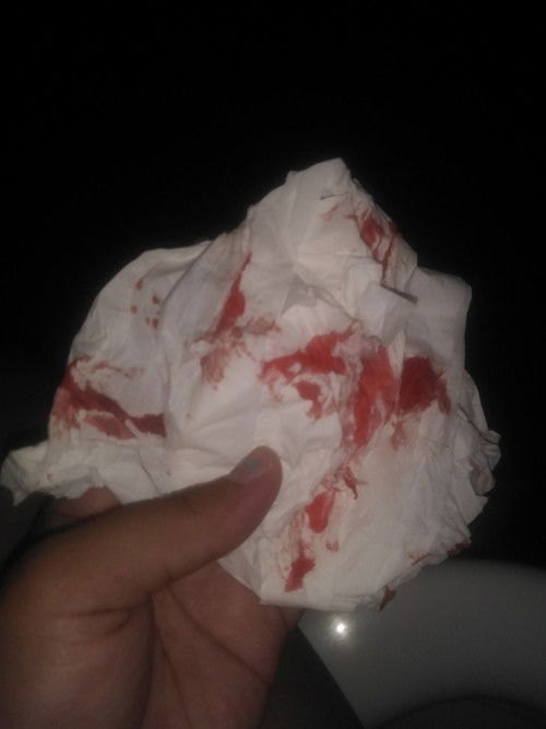 แม่ๆค้าทเาเกิดแบบนี้จะเป็นอะไรป่าวค่ะน้องผึ้งได้2เดือน