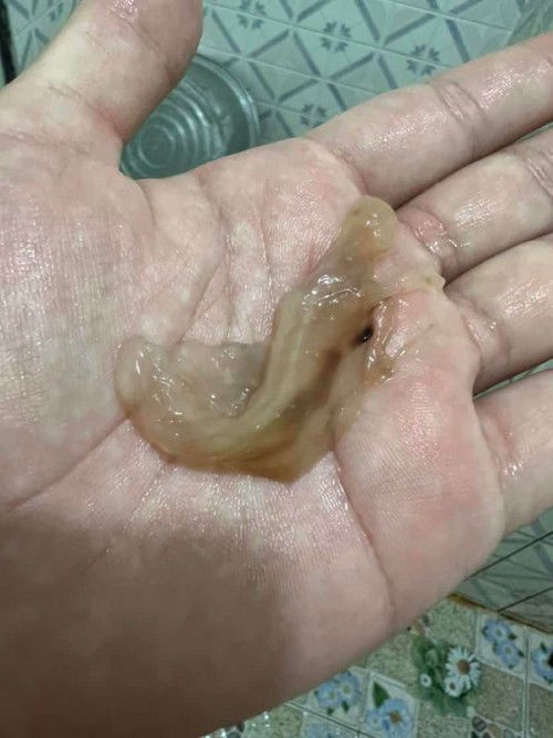 แบบนี้ใช่มูกเลือดไหมคะ?