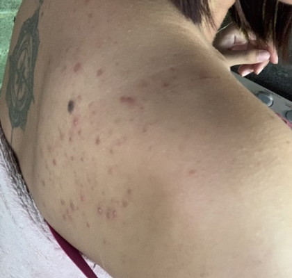 สิวขึ้นหนักมากก