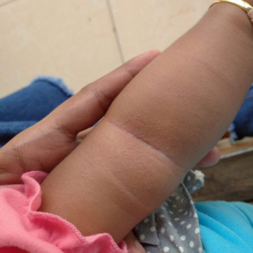 Gatal pada bayi 4,5 bulan