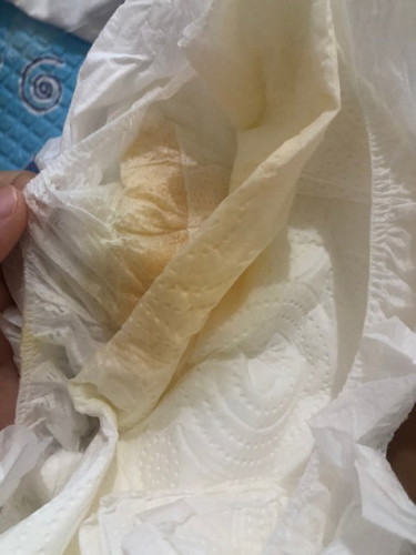 ฉี่ออกสีส้ม แบบนี้ปกติมั้ยคะ