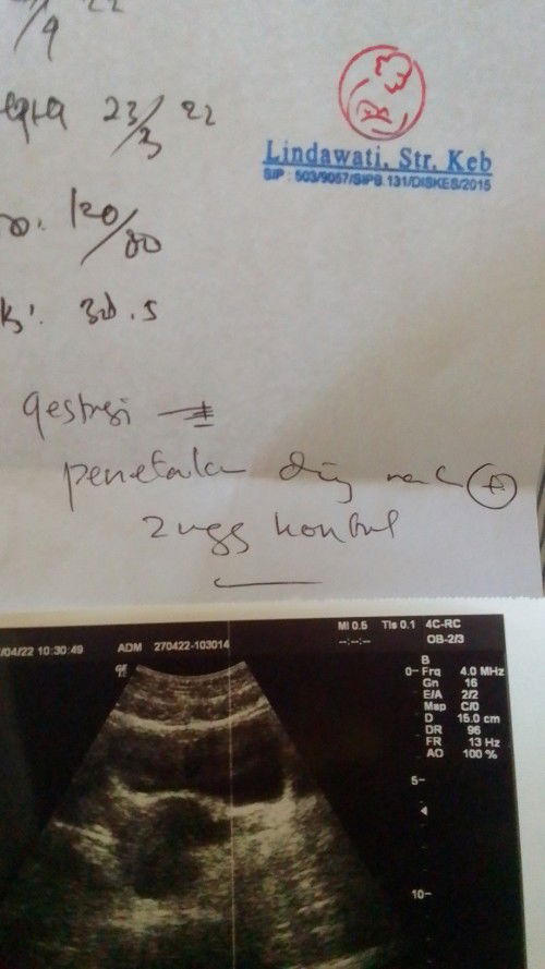 Janin Tidak Berkembang