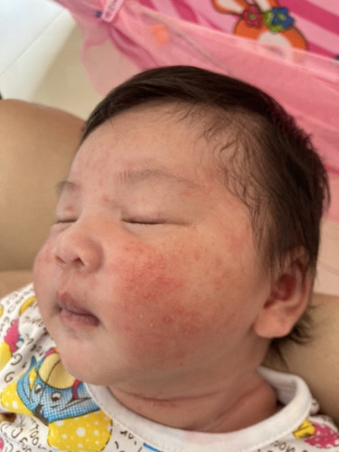 ผื่นขึ้นเต็มหน้าลูก