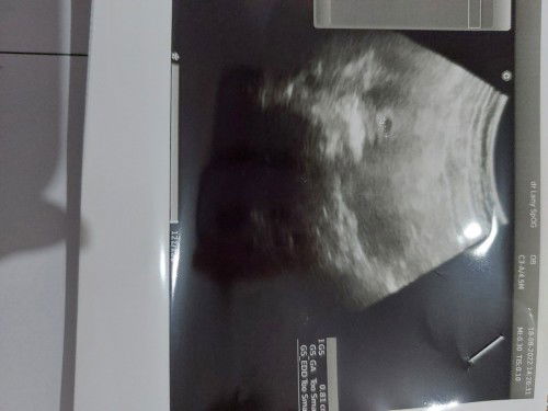 Sharing dong bund usia kehamilan