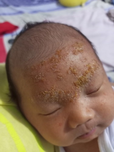 Rashes sa Mukha ni Baby