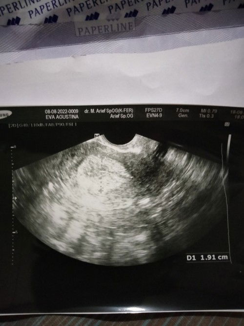 Ass Bun.. saya mau tny apakah ada sprt sy di usia kndungan 6pekan 3 hr msh pnebalan dinding rahim?🥺