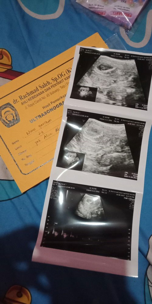 Usia kndungan 6w2d uda terdengar detak jntung