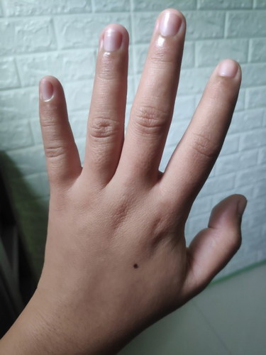 Lumaki na kamay at paa ko
