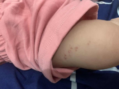 Kulit bayi ada bintik merah