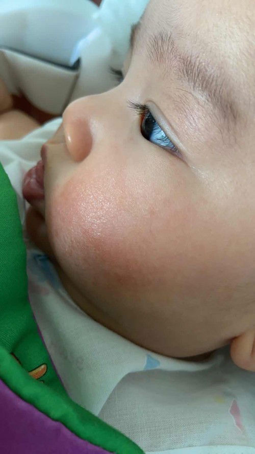 แก้มเป็นผื่นแดง เป็นเพราะอะไรคะ