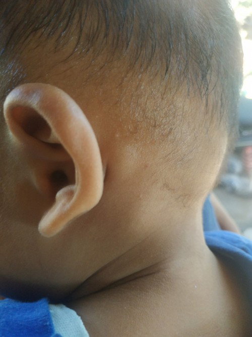 Benjolan pada belakang telinga bayi