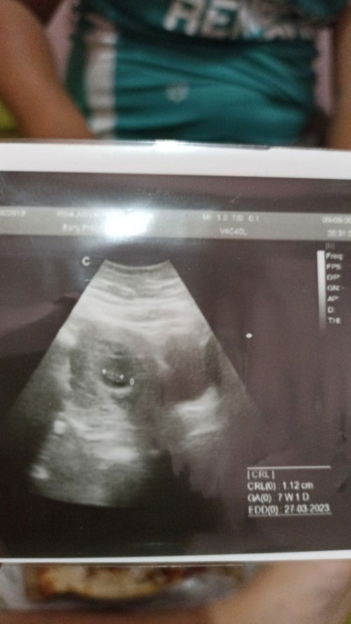 Janinku tdk berkembang stuck di 7 week