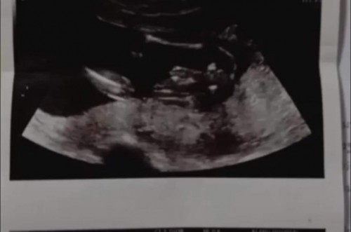 23week อยากทราบเพศ