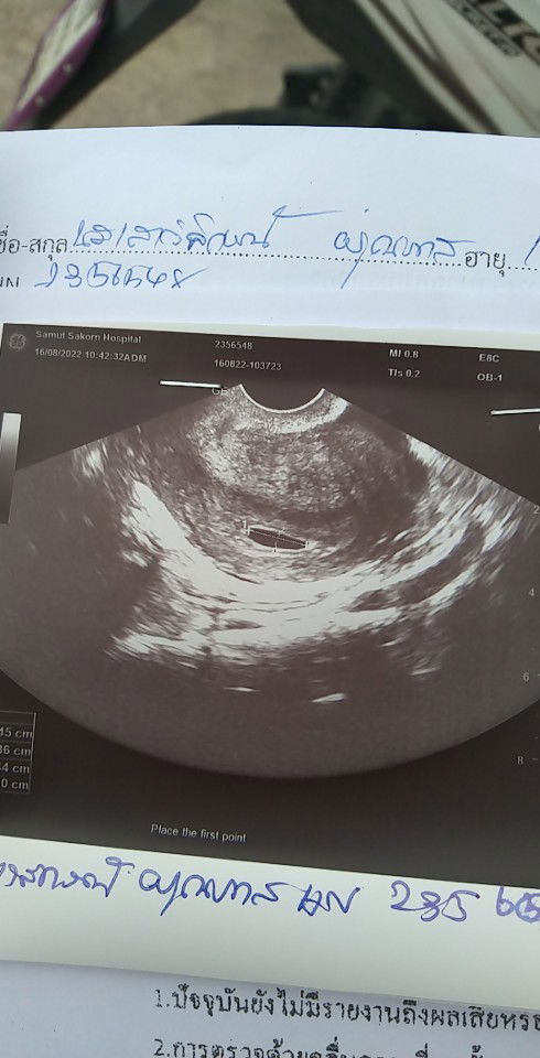 ท้อง2ค่ะ เเต่ท้องเเรก มารู้ตัวเองตั้งครรภ์ได้ประมาน5-6เดือนค่ะ ไม่ได้สักเกตุ