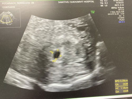 เลือดสีน้ำตาลออก อายุครรภ์ 5w4d