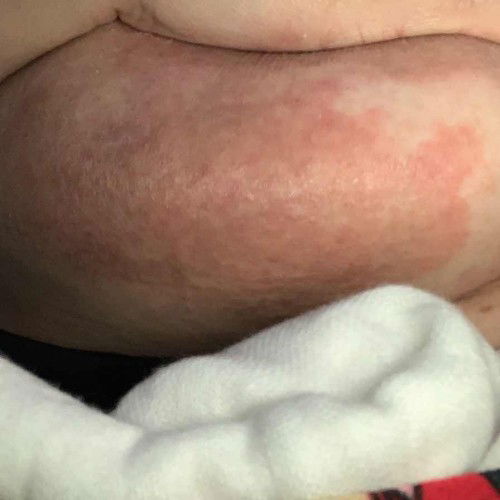 Breast Rash