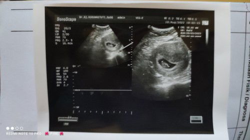 Usia 8w 2d sudah terdeteksi DJJ