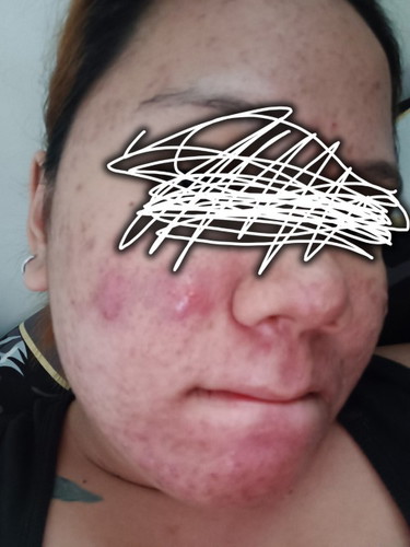 Pimples in pregnancy