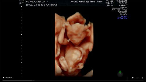 Các mẹ dự sinh t1 năm sau đã đỡ mệt hơn chưa ạ