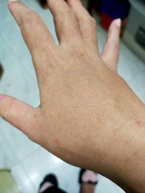 Rashes during pregnancy