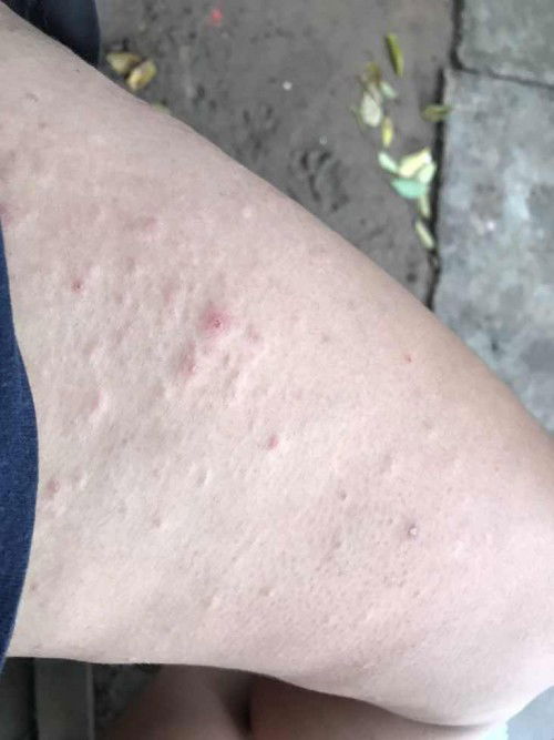 ผื่นคัน ทรมานมากๆ เลยค่ะ