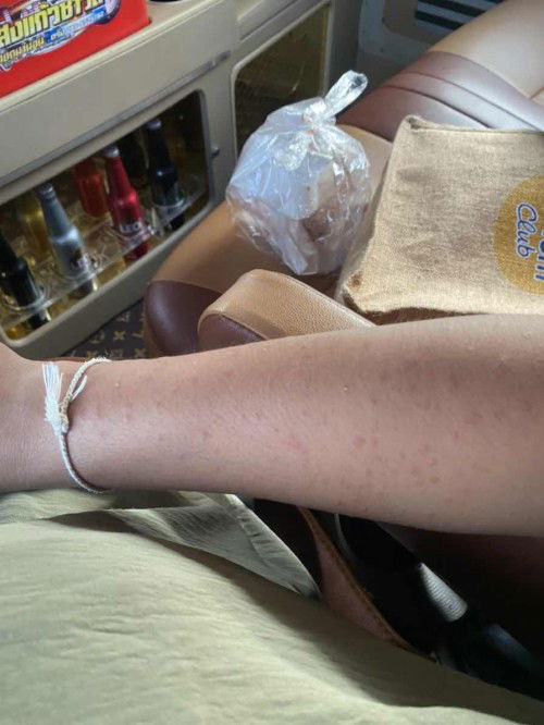 แตกแบบนี้เคยเปนกันมั้ยค่ะคันมากยิ่งเวลาร้อนคล้ายๆลมพิษเลยมาเป็นตอนไกล้คลอด28สิงหานี้คันมากไม่ได้นอนเลยค่ะมียาตัวไหนช่วยได้บ้าง