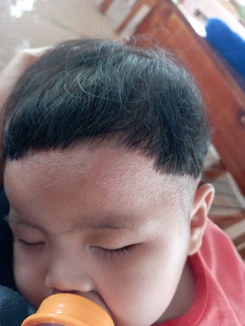 ผื่นเเดงเม็ดเล็กตามเขนเเละหน้าผาก