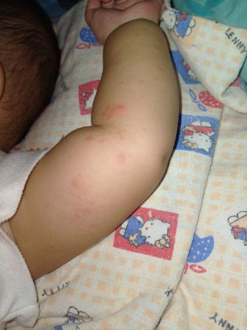 Bentol merah pada kulit bayi