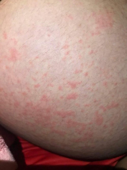 สอบถามหน่อยค่ะ ท้องได้8เดือนกว่าจะ9เดือนแล้วมีผื่นขึ้นเป็นอันตรายอะไรไหมคะ