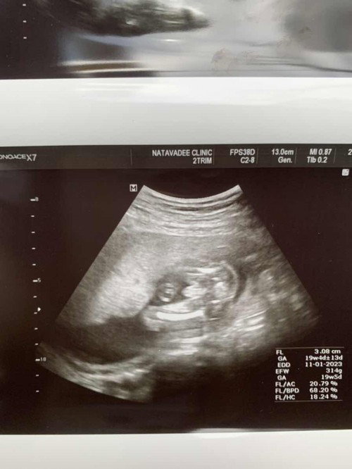 แบบนี้ผู้หญิงหรือผู้ชายคะ 19week
