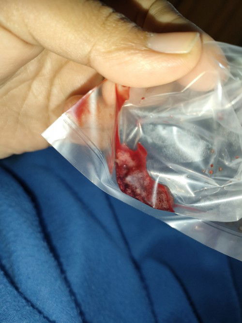 Pendarahan dan harus di Kuret