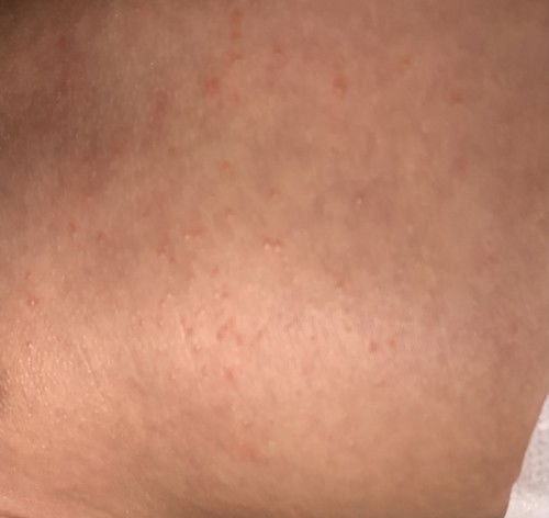 Bintil bintil merah di badan