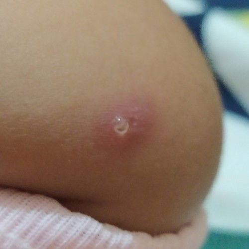 bekas suntikan BCG