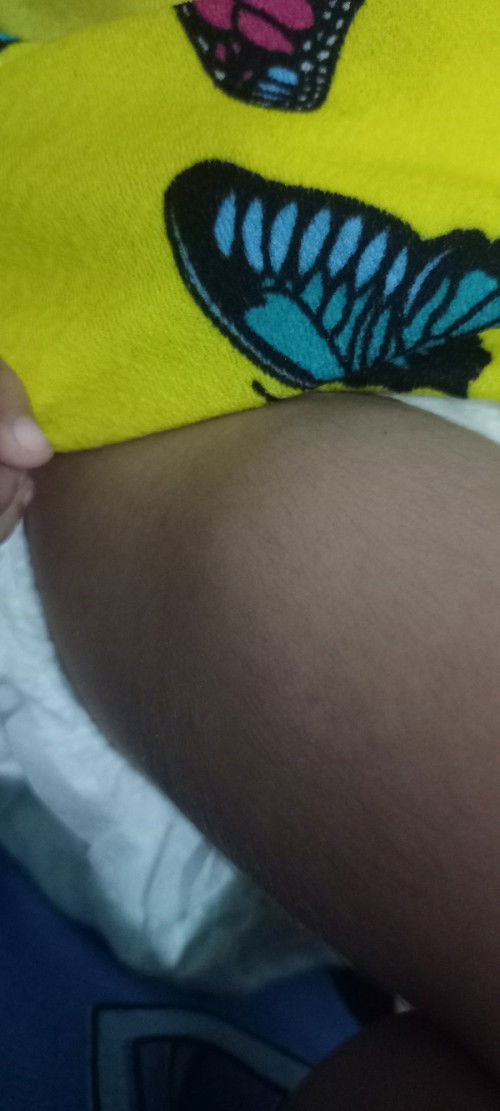 Bukol sa hita ni baby dahil sa bakuna