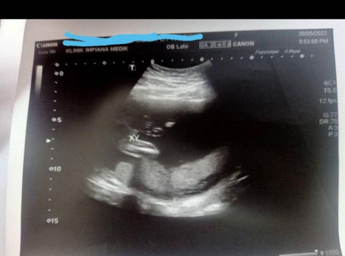 Ini baby apa ya? Dr. cakap boy... agak2 mommy semua ni boy ke girl ye?