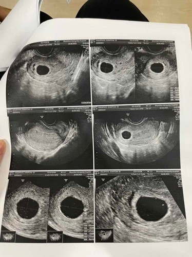 สอบถามค่ะ 9W4D ตรวจขีดเส้น2 ท้องแน่แต่ไม่เห็นตัวเด็ก เคยทำแท้งมาก่อน2ปีแล้ววันนี้แปลกสงสัยผิดปกติ ท้องลมหรือนอกท้องมดลูก 😢