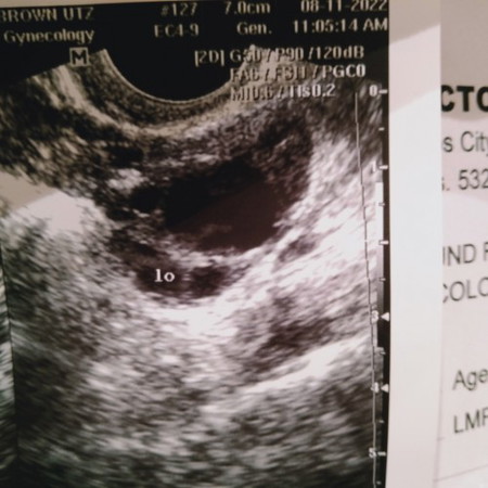 Hi mga mommy, my LMP is July 24-28 and Aug 10-15 is my Fertile days (TTC)