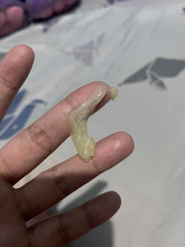 Vaginal Discharge