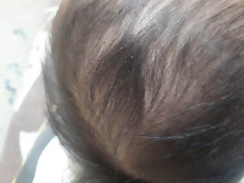 Anak 2th kulit kepalanya kering seperti ketombean