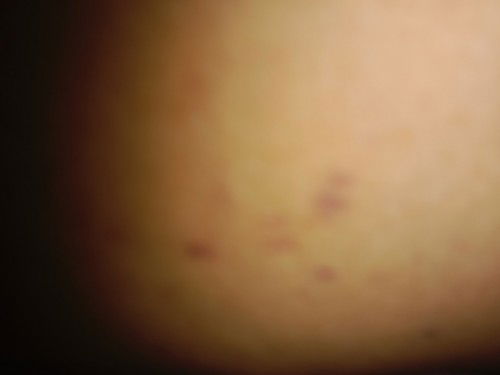 Gatal gatal pada kulit