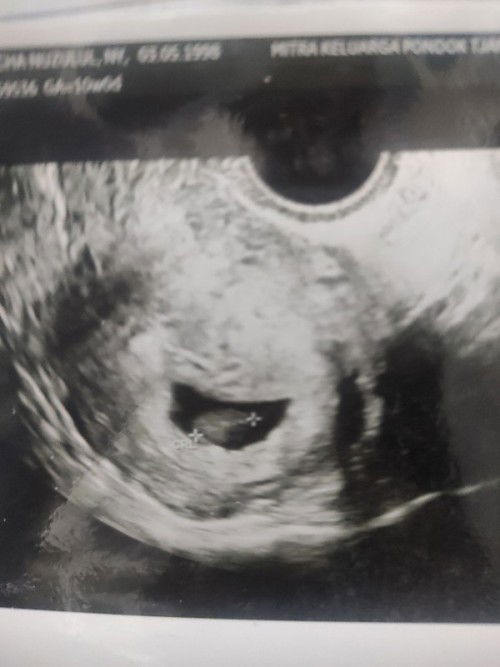 Kantung tidak beraturan djj negatif 8 w