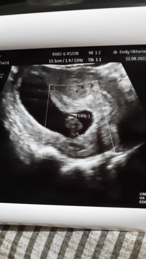 Usg transvaginal tapi disuruh kuret secepatnya